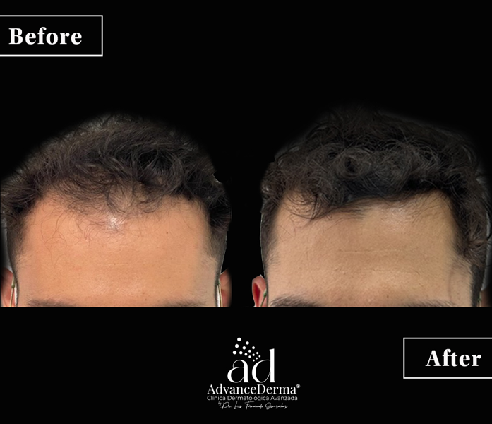 Alopecia 1