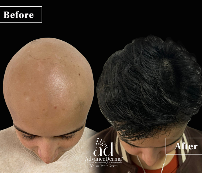 Alopecia 2