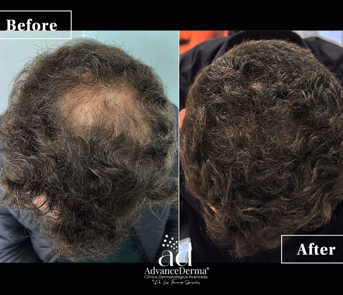 Alopecia 3
