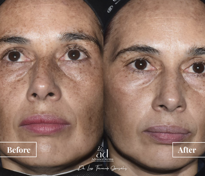Melasma 1