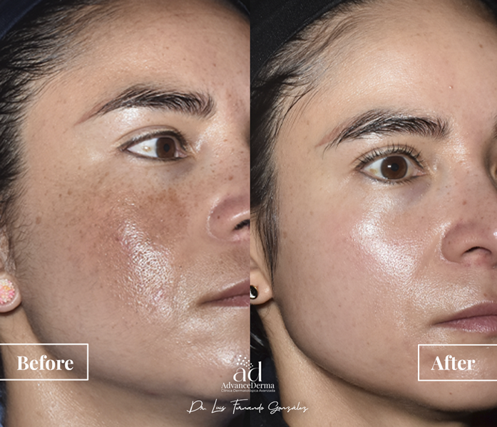 Melasma 2