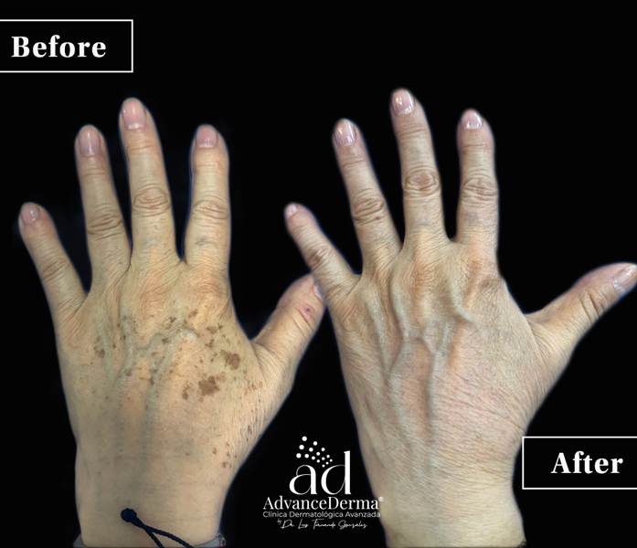Melasma 3