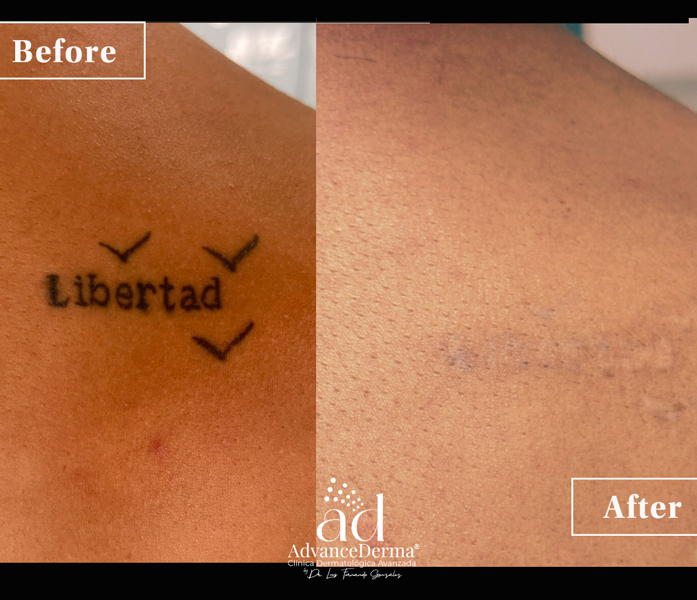 Remosin de Tatuajes 1