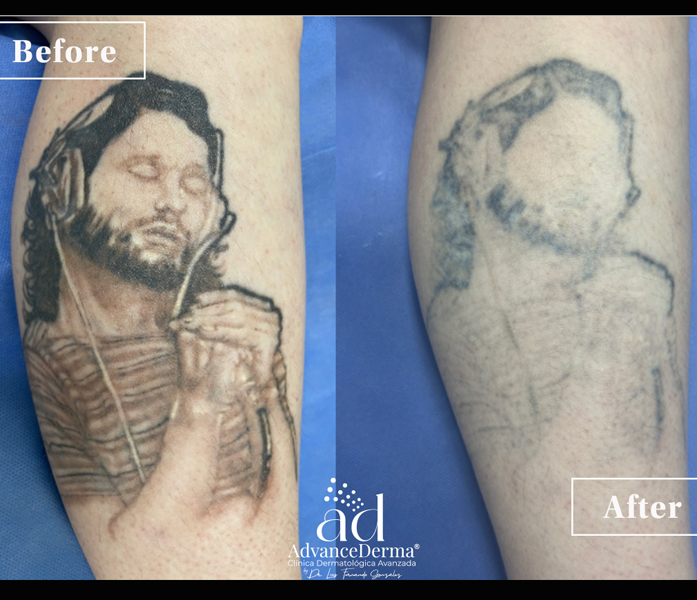 Remosin de Tatuajes 2