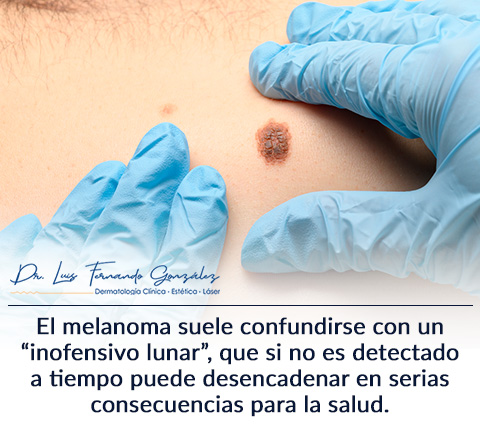 23 de Mayo: Da Mundial del Melanoma, un Cncer de Piel.