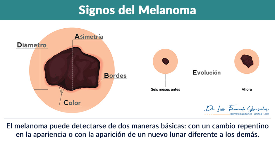 23 de Mayo: Da Mundial del Melanoma Grfica de Signos.