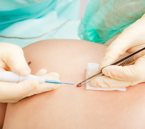 Disfruta de la mejor cirugía dermatológica en Bogotá Paciente en una cirugía dermatológica en Bogotá