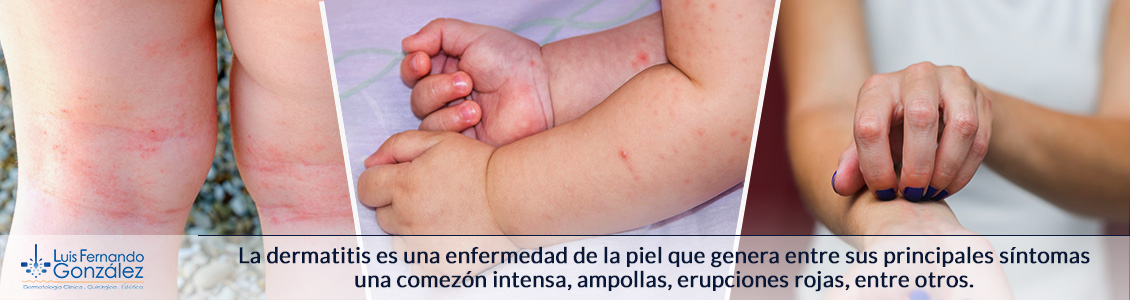 La Dermatitis Atópica puede llegar a resolverse a la edad de 36 meses Dermatitis Atópica Manchas Picazón