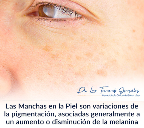 Manchas en la Piel