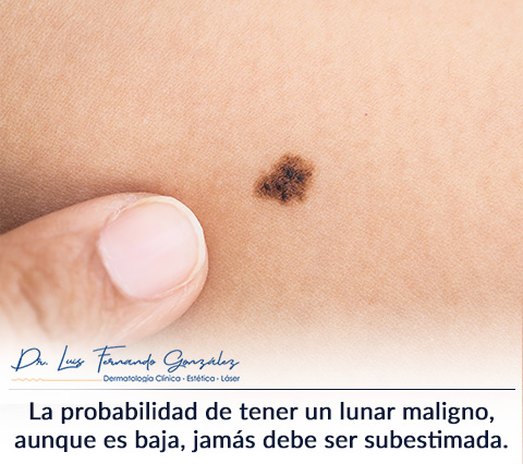 Un Lunar Maligno Evaluado por un Dermatólogo en Bogotá