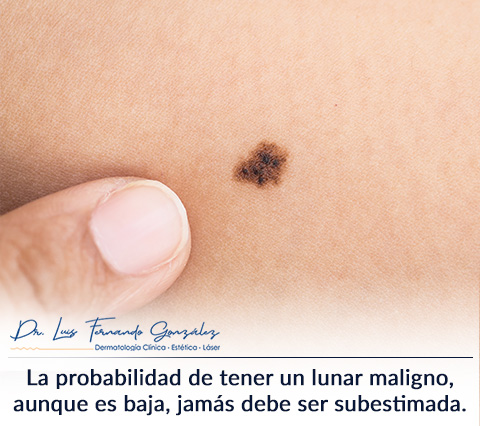 Un Dermatólogo es el Especialista Indicado para Evaluar los Lunares Un Lunar Maligno Evaluado por un Dermatólogo en Bogotá