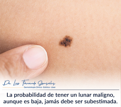 Un Lunar Maligno Evaluado por un Dermatlogo en Bogot