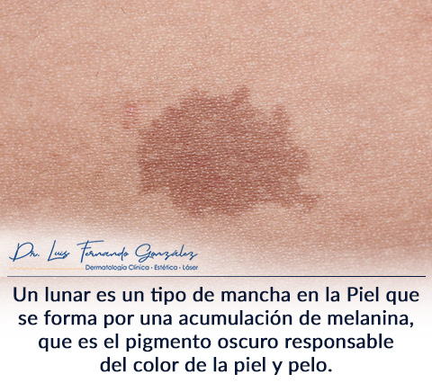 Para Determinar si un Lunar es Maligno o no, debe ser evaluado por un Dermatólogo Lunar en la Piel
