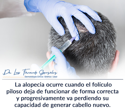 Dermatologo Explica Cuales son los Tipos de Calvicie