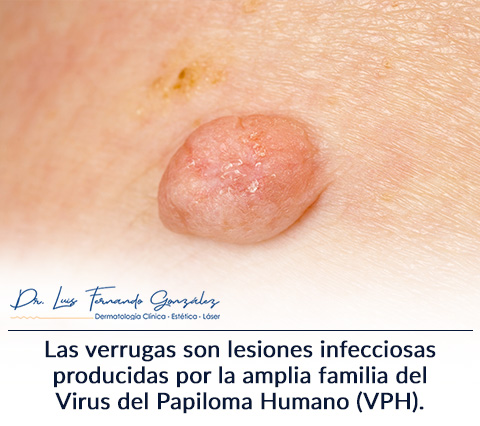 Verrugas: Causas, Tratamientos y Extraccin.