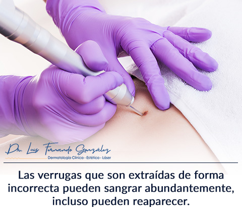 Verrugas: Causas, Tratamientos y Extraccin por un Dermatlogo.