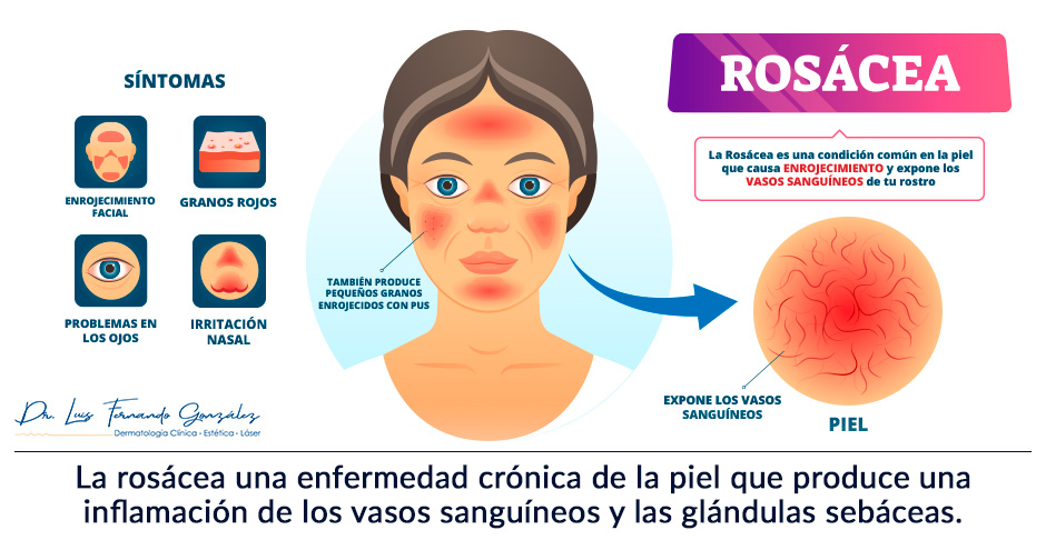 Ilustracin Para Conocer Sobre el Tratamiento de la Roscea.