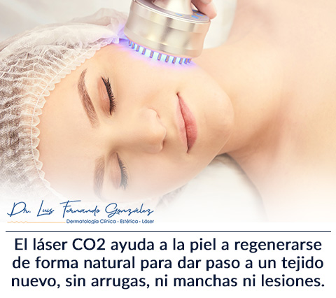 Todo Sobre el Rejuvenecimiento Facial con Lser CO2.