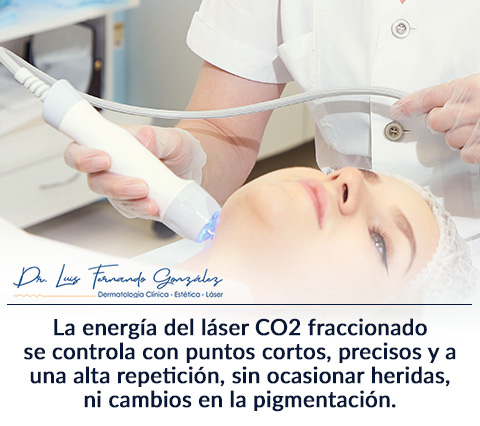 Mujer Descubre Todo Sobre el Rejuvenecimiento Facial con Lser CO2.